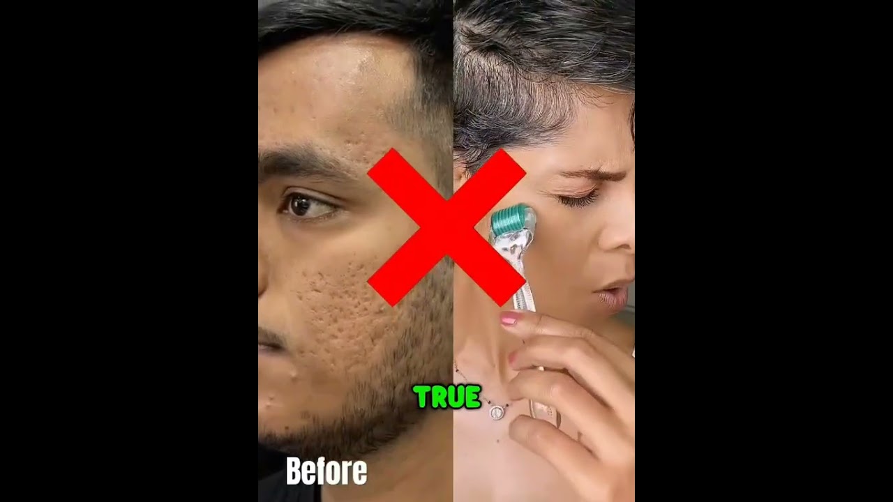 How Microneedling Makes Your Skin Look Younger