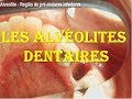 Les alvéolites dentaires