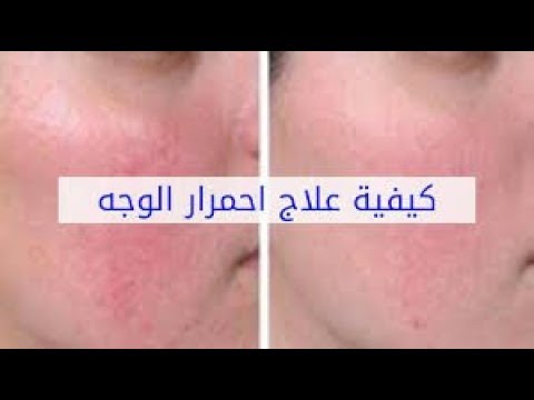 ما سبب احمرار الوجه وكيفية علاجه بالاعشاب الطبيعية Youtube