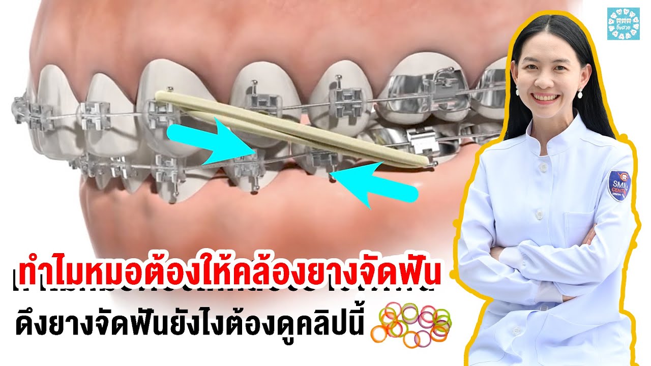 ทำไมหมอต้องให้คล้องยางจัดฟัน ดึงยางจัดฟันยังไงต้องดูคลิปนี้ - Youtube