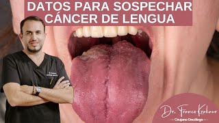 Datos Para Sospechar Cáncer de Lengua/ Dr. Franco Krakaur/ Cirujano Oncólogo