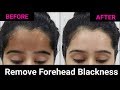 Get rid of Black Forehead + Whiten & Brighten your Skin Naturally