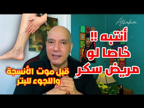 أعراض تنذر بضيق شرايين الساق بسرعه أكشف أوعية دموية