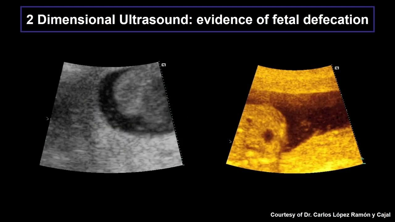 12 Meconiumstained amniotic fluid YouTube