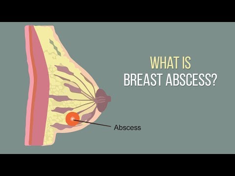 What is breast abscess  I Dr.Pankaj Parekh | Dr. Priti gangan | Lactation Series | child and you