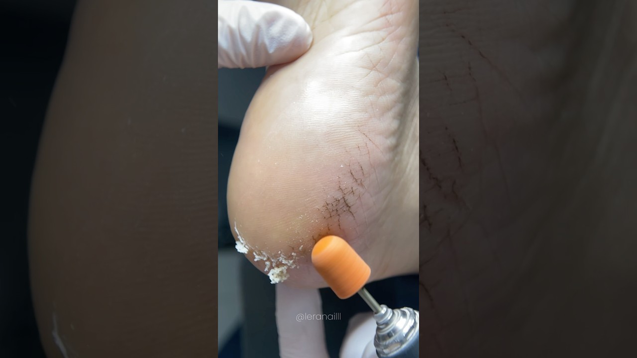 Обработка стопы.Система препаратного педикюра 10|11 