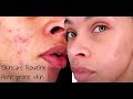 UPDATED ACNE SKINCARE ROUTINE - TRAINING BEAUTICIAN