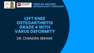 VIRRD 2024 : Left knee osteoarthritis grade 4 with varus deformity - DR. CHANDRA SEKHAR screenshot 1