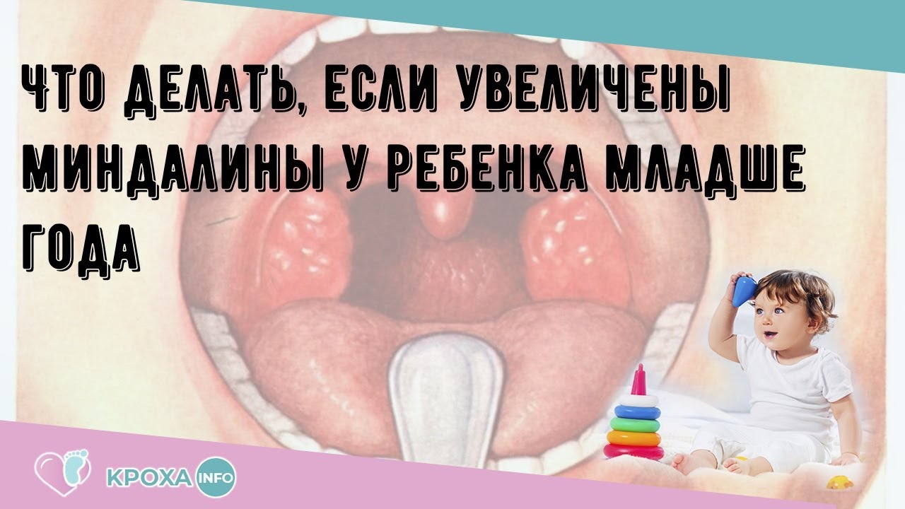 Что делать, если увеличены миндалины у ребенка младше года - YouTube