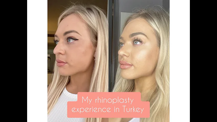 Rhinoplasty Experience in Istanbul