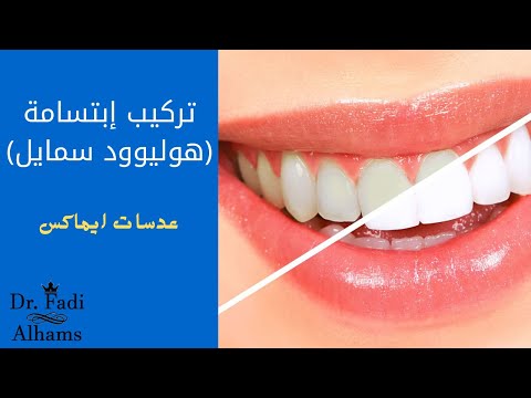 طريقة تركيب الابتسامه هوليوود سمايل عيادة الدكتور فادي الهمص للتواصل والحجز 0501821415