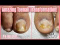 👣Big Toes Only - Amazing Pedicure Transformation Follow Up on a Detached Toenail 👣