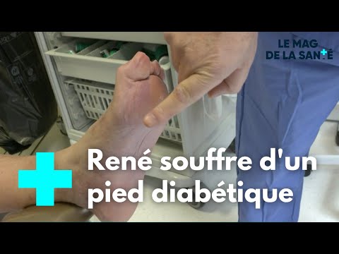 Vidéo: Comment vérifier les pieds pour les complications du diabète : 10 étapes