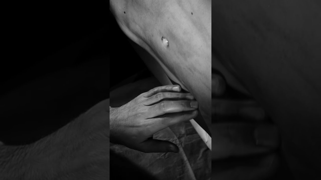 Liposucción abdomen hombre con definición y lipotrasnferencia (Liposucción de alta definición)