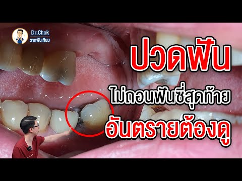 ปวดฟัน ไม่ถอนฟันซี่สุดท้าย อันตรายต้องดู ?!! | คลายปัญหารากฟันเทียมกับหมอโชค