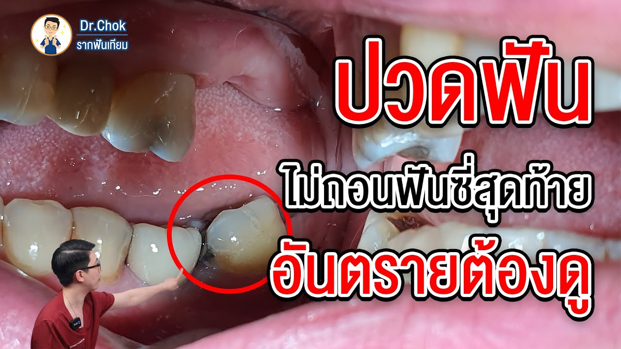 ปวดฟัน ไม่ถอนฟันซี่สุดท้าย อันตรายต้องดู ?!! |  คลายปัญหารากฟันเทียมกับหมอโชค - Youtube