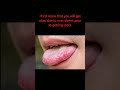 How To Get Heal Of Ulcer In Tongue Ulcer Tongue How To Get Heal Of Ulcer In Tongue Ulcer Tongue