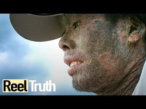 My Skin is Killing Me - Epidermolysis Bullosa | Extraordinary People Documentary | Reel Truth