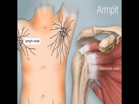 2017 ICD-10-CM Diagnosis Code L02.411 : Cutaneous abscess ...