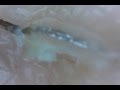 #6 超スッキリ!毛根鞘を引っこ抜き!(Pull out hair root & root sheath)