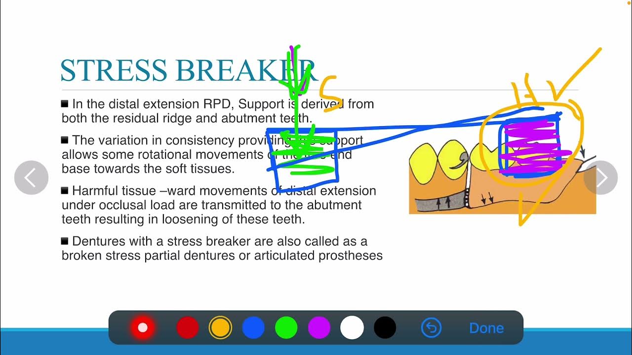 314 Prosthodontics, Stress Breaker Stress Equalizer. YouTube