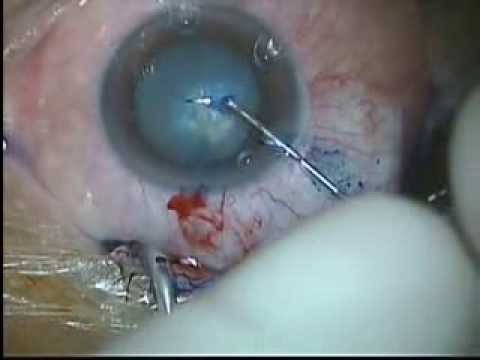 Mature white Cataract Surgery, Staining with Vision Blue