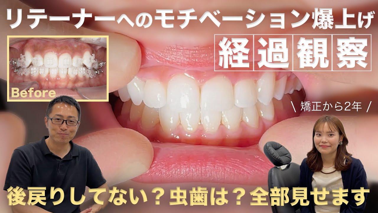 【矯正後】2年経った歯並びは？先生もびっくりの結果！あなたもリテーナーを頑張りたくなるはず！【経過観察】