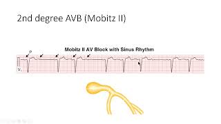 EKG Video 5.0