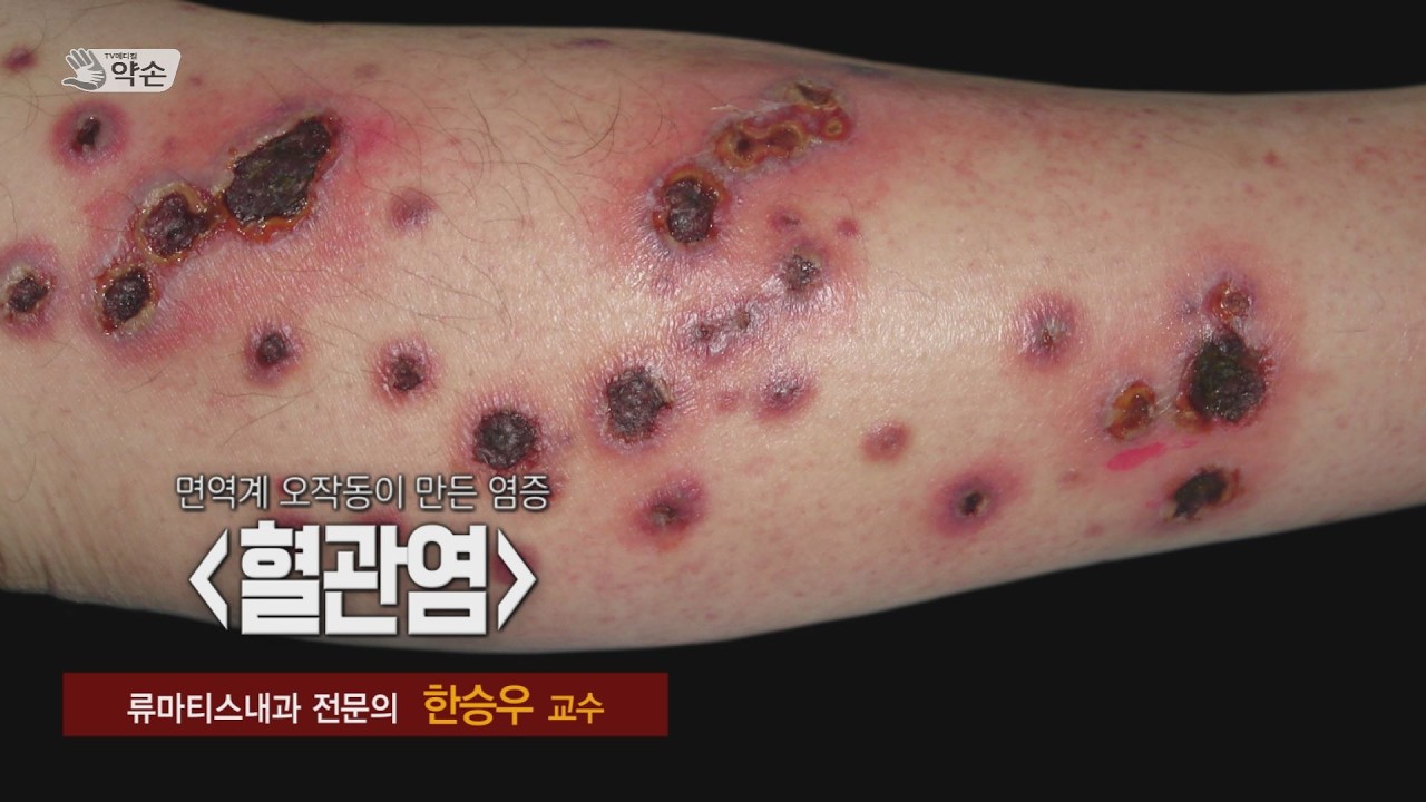 [TV메디컬 약손] 832회 혈관염