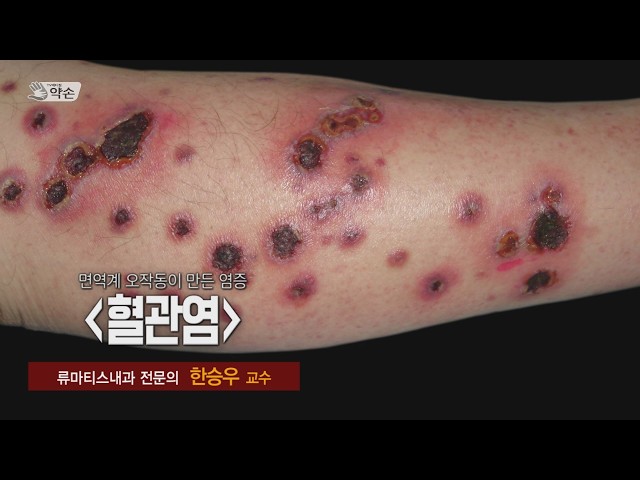[TV메디컬 약손] 832회 혈관염