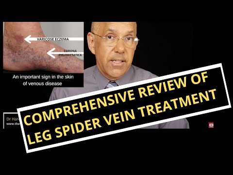 What Are Leg Spider Veins and How Can I Remove Them? | A Review of Causes and Treatments