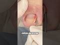 Queimaram o dedo dele e a unha ficou la dentro! Assista completo
