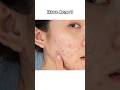DIY Acne & Glow Face Mask