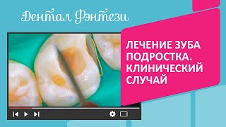 👉 🦷  Лечение зуба подростка. Клинический случай