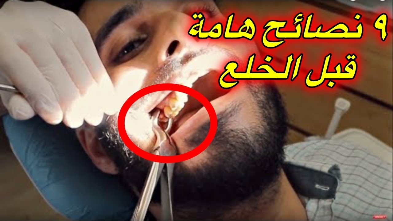 9 نصائح قبل خلع ضرس العقل بدون ألم وبدون إصابة Youtube