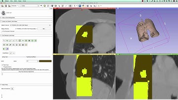 Segmentation of lung and nodule in CT using 3D Slicer