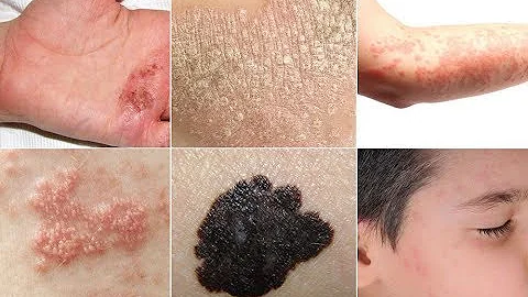 Quelle maladie provoque des taches sur la peau