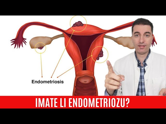 Prepoznajte ENDOMETRIOZU na ovaj način...