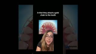 Impacted Canine Procedure