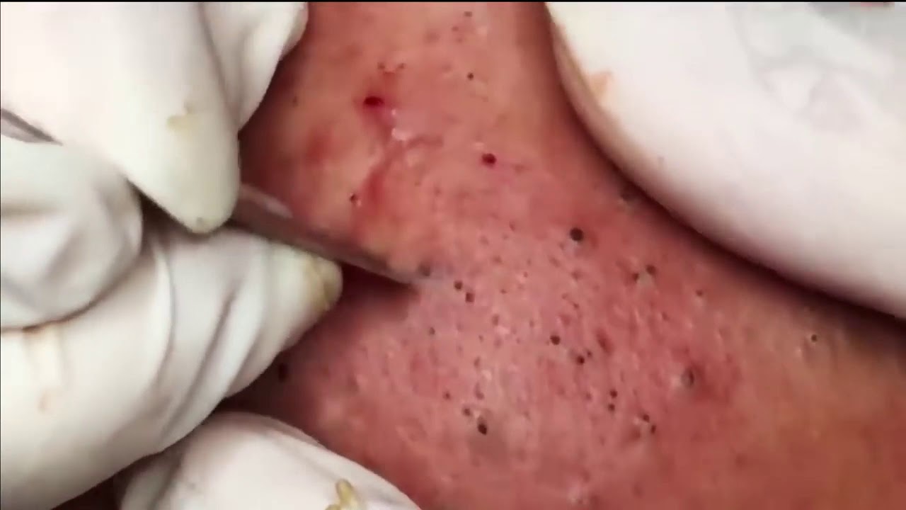 Blackhead removal - YouTube