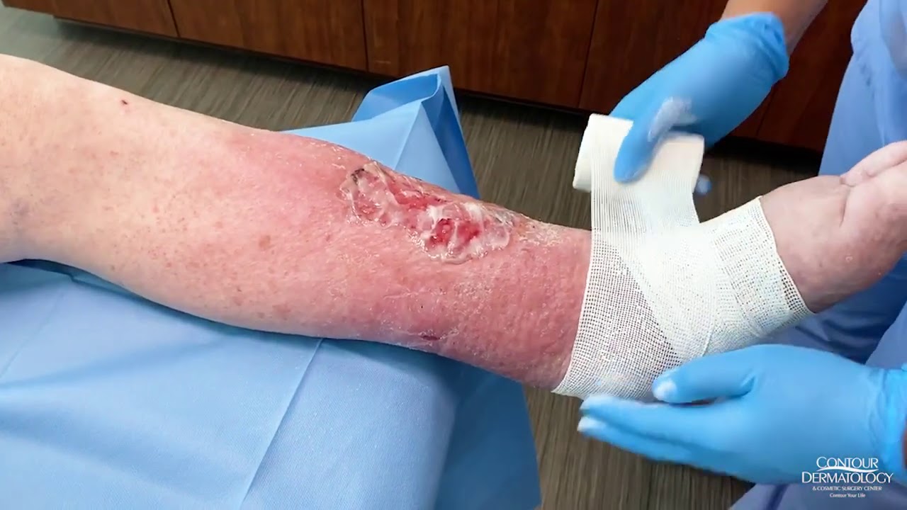 Dressing an Open Wound (Leg Ulcer)