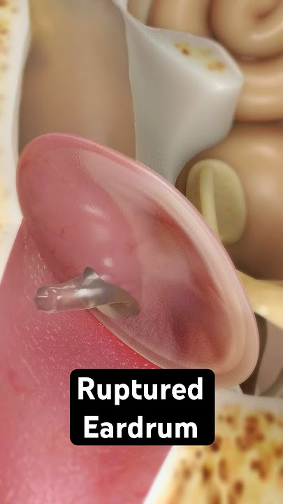 How does an eardrum rupture? (3D Animation)