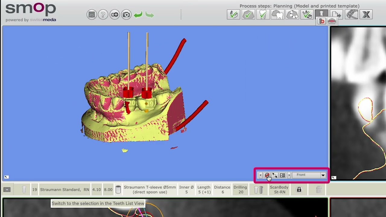 Smop: Planning a Posterior Bridge with Parallel Implants