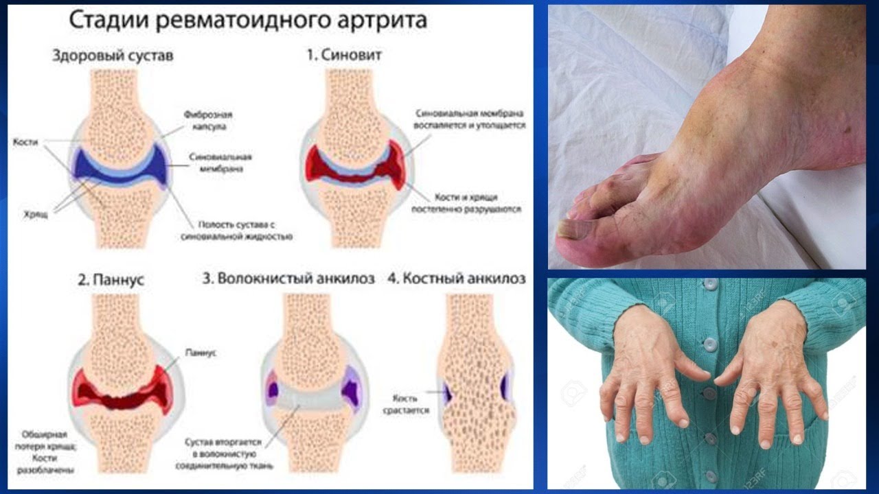 Артрит артроз тазобедренного сустава. Ревматоидный артрит классификация коленный сустав. Ревматоидный паннус микропрепарат.