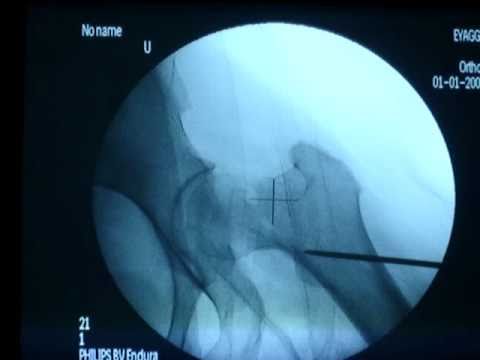SUBCAPITAL HIP FRACTURE,