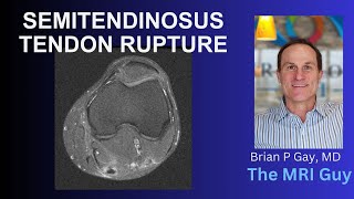 Semitendinosus tendon rupture