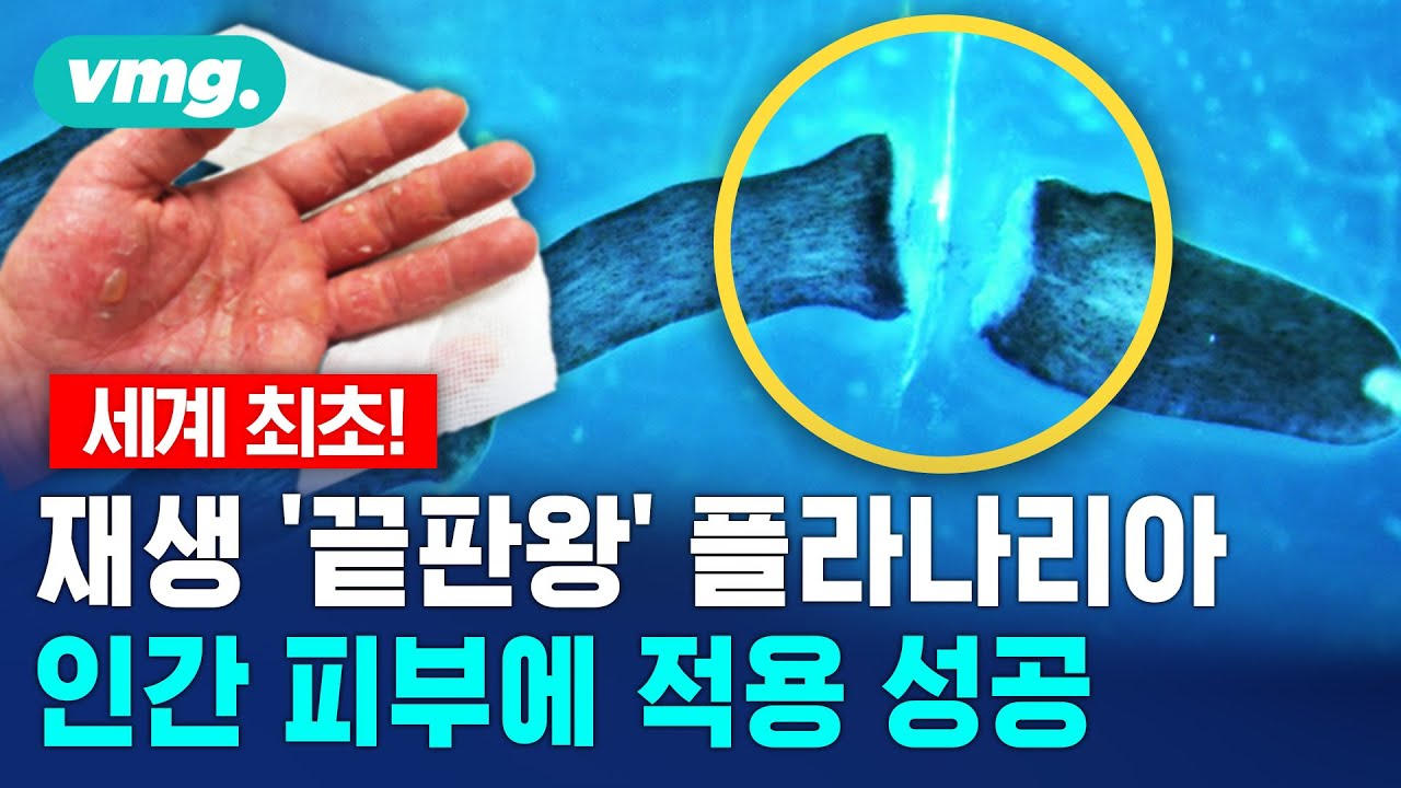 세계 최초 재생 '끝판왕' 플라나리아 인간 피부에 첫 적용 / 비디오머그