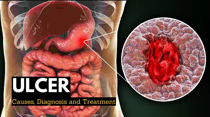 Ulcer, Causes, Signs and Symptoms, Diagnosis and Treatment. - DayDayNews