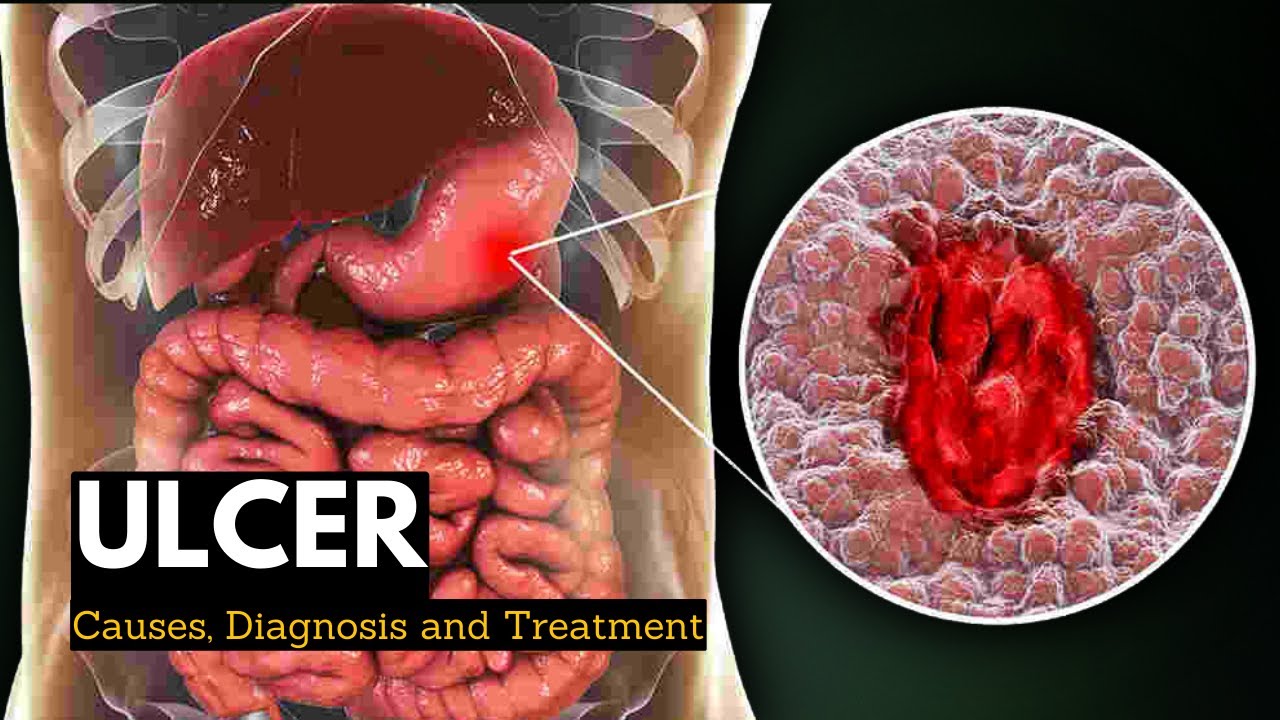 Ulcer, Causes, Signs and Symptoms, Diagnosis and Treatment. - YouTube