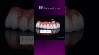 RR Dental Labs Fire & Forget Implants & I-Dent Aligners Trusted Digital Dental Lab in India